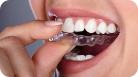 Receive Your Aligners