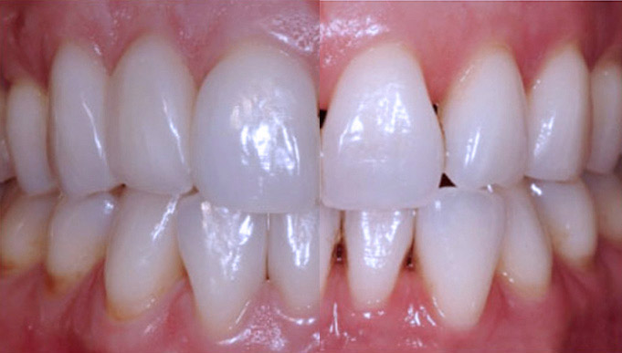 Up Close Shot of Straight, White, Clean Teeth