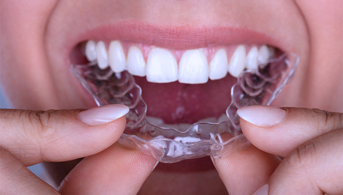 Women Putting Invisalign Retainer in Mouth