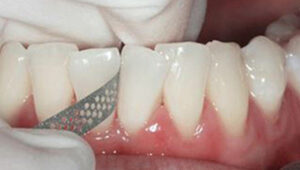 teeth file